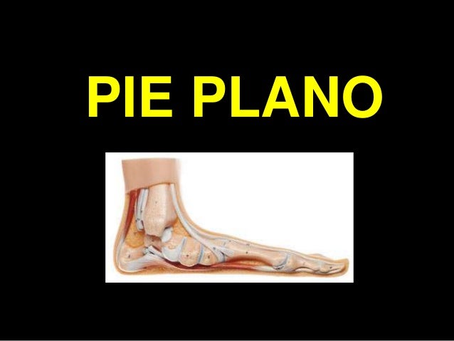 PIES PLANOS VALGOS